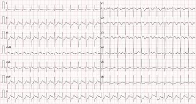 An Atypical Anomalous Aortic Origin of the Left Coronary Artery With Intra-Arterial Wall Course Pretending a Normal Migration on Imaging Screening: A Case Report